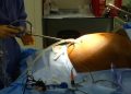 Chirurgie bariatrique : solution médicale ou signal d’alerte ?   